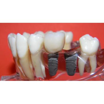 Implant dentar din titan - Pret | Preturi Implant dentar din titan