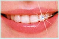 strasuri dentare - Pret | Preturi strasuri dentare