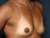 Implant mamar,implanturi mamare - Pret | Preturi Implant mamar,implanturi mamare