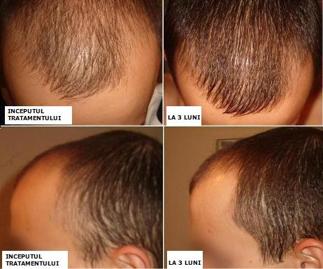 Tratament impotriva caderii parului (cheliei, calvitiei, alopeciei avansate) - Pret | Preturi Tratament impotriva caderii parului (cheliei, calvitiei, alopeciei avansate)