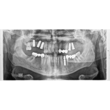 Implant dentar - Pret | Preturi Implant dentar
